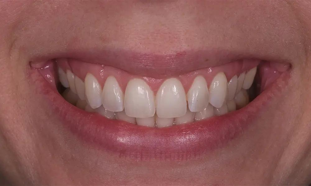 Smiling Chicago 8 Gum grafts after