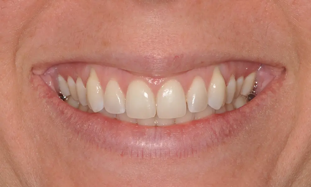 Smiling Chicago 7 Gum grafts before