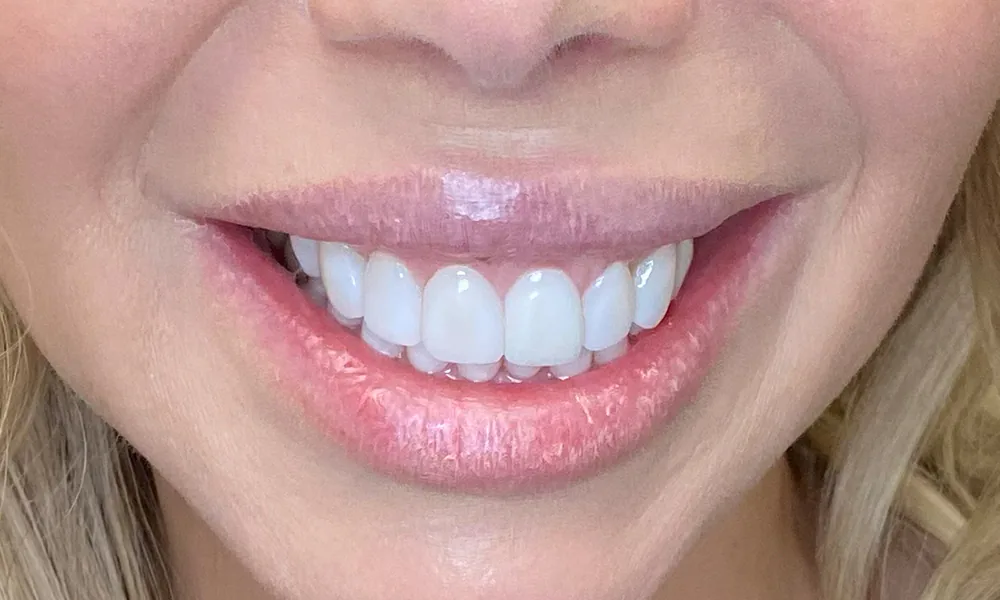 Smiling Chicago 10 Gummy smile recontouring and porcelain veneers after