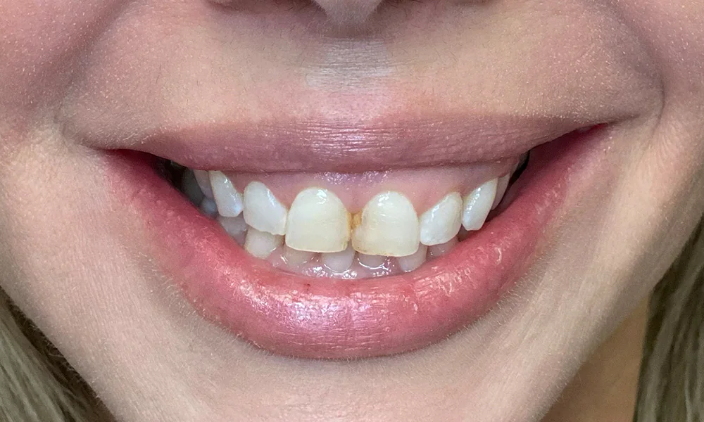 Smiling Chicago 9 Gummy smile recontouring and porcelain veneers before