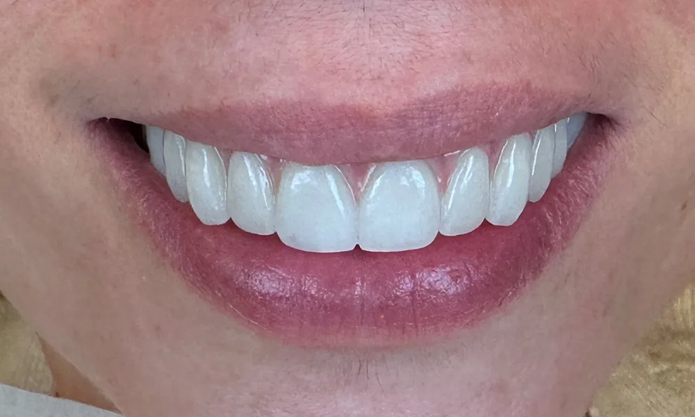 Smiling Chicago 12 Upper All on X Zirconia digital protocol before after