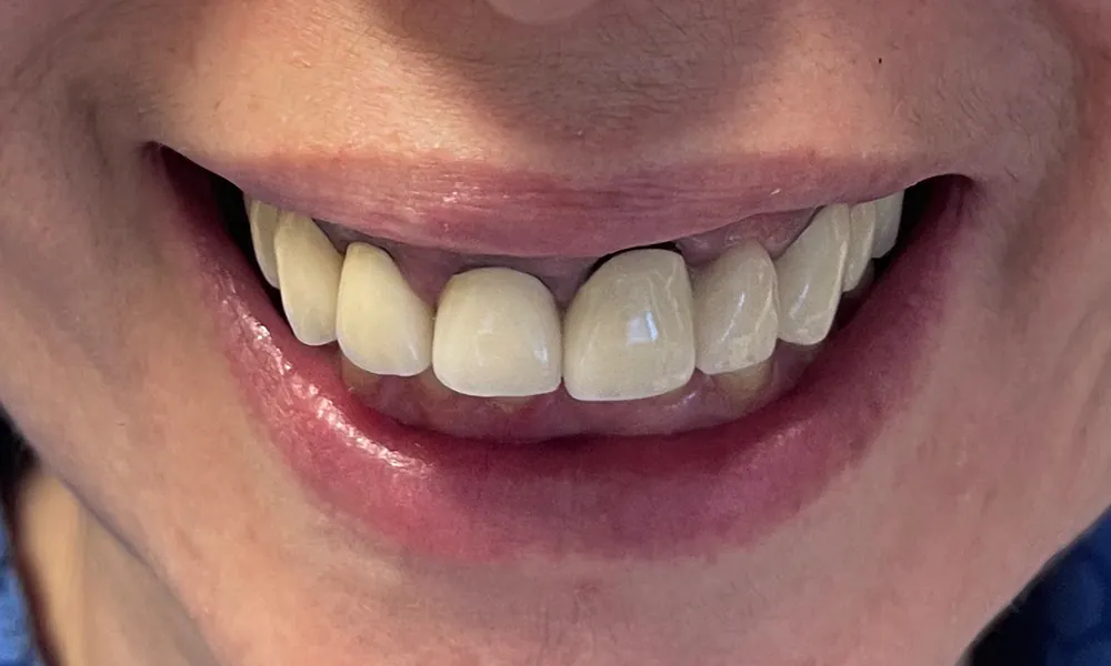Smiling Chicago 11 Upper All on X Zirconia digital protocol before