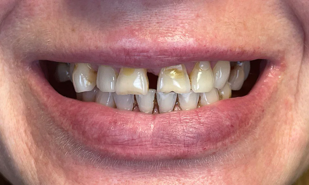 Smiling Chicago 13 Upper arch All on X before