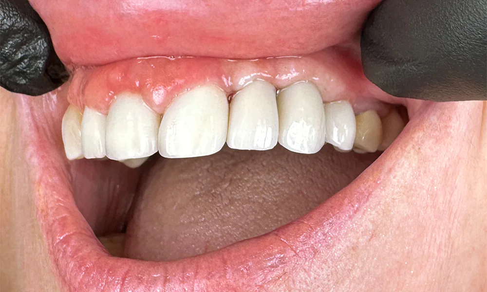 Smiling Chicago 16 Upper left implants and crowns before after