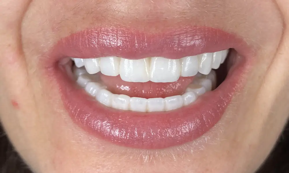 Smiling Chicago 6 Very loose and hopeless teeth replaced with implant supported zirconia bridges after 2