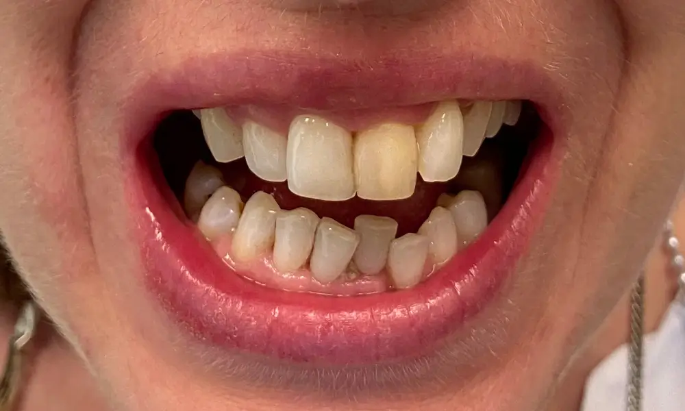 Smiling Chicago 5 Very loose and hopeless teeth replaced with implant supported zirconia bridges before